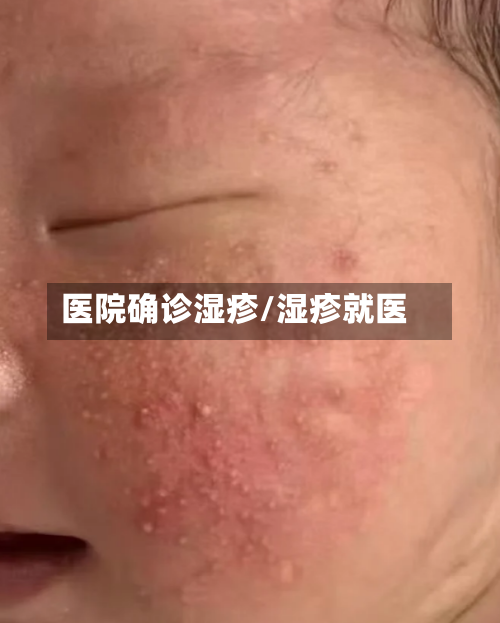医院确诊湿疹/湿疹就医