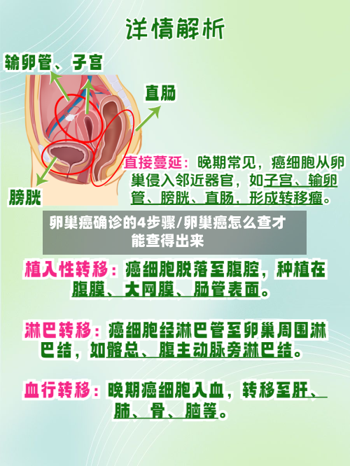 卵巢癌确诊的4步骤/卵巢癌怎么查才能查得出来
