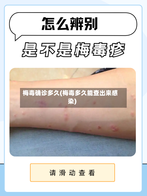 梅毒确诊多久(梅毒多久能查出来感染)-第2张图片