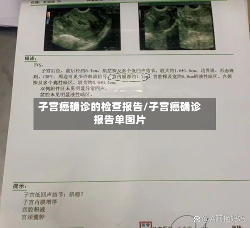 子宫癌确诊的检查报告/子宫癌确诊报告单图片