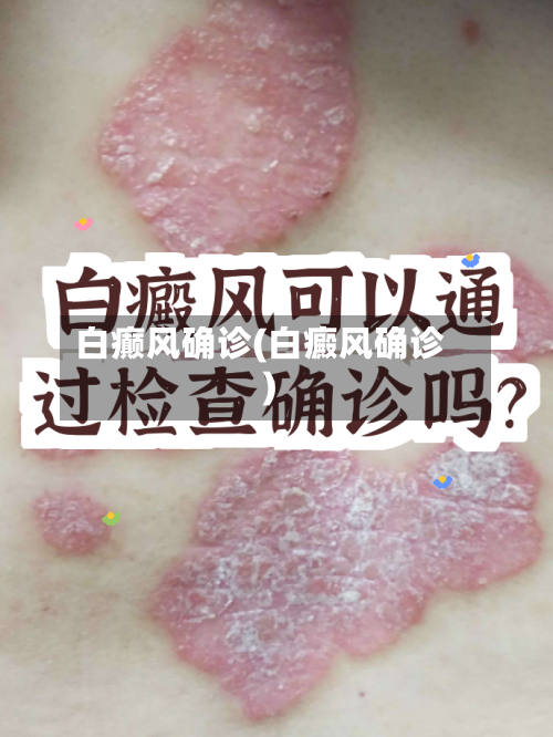 白癫风确诊(白癜风确诊)-第2张图片
