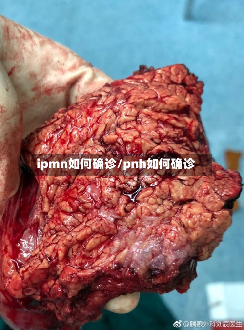 ipmn如何确诊/pnh如何确诊