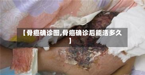 【骨癌确诊图,骨癌确诊后能活多久】-第2张图片